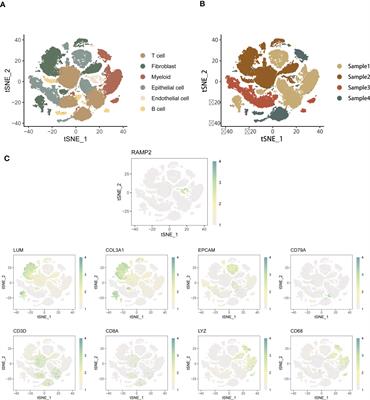 Machine learning-assisted analysis of epithelial mesenchymal transition pathway for prognostic stratification and immune infiltration assessment in ovarian cancer